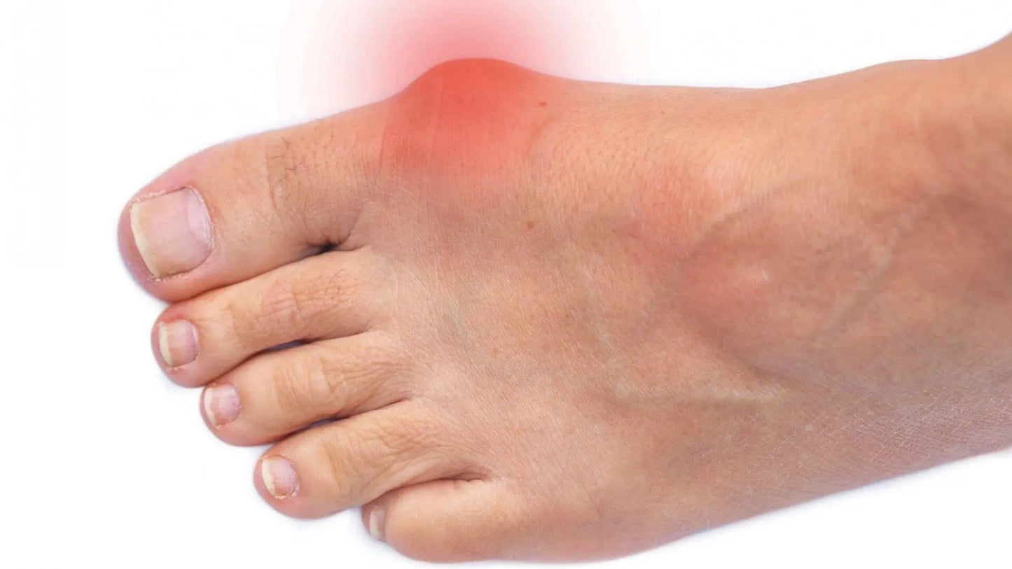 Foot with bunion pain and swelling at big toe joint, illustrating common cause of foot pain needing relief or alignment support