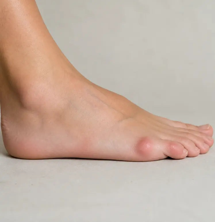 Tailor's Bunion Pain Relief Socks: What They Are, Why They Hurt, and How to Get Relief