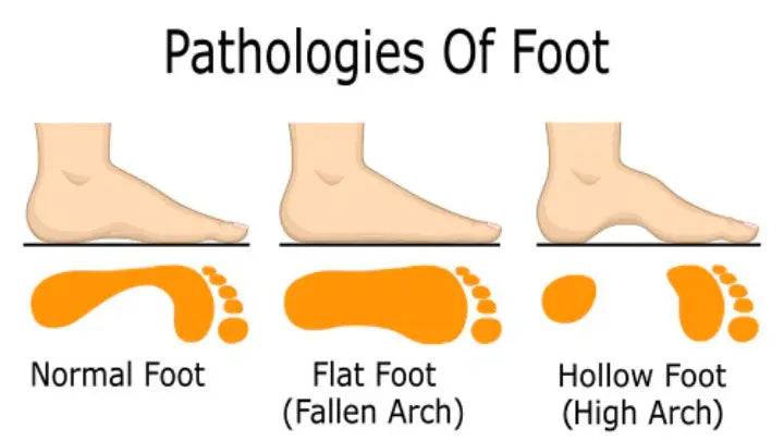 Flat Feet? NeuroSox Arch Support Socks Could Change the Way You Walk