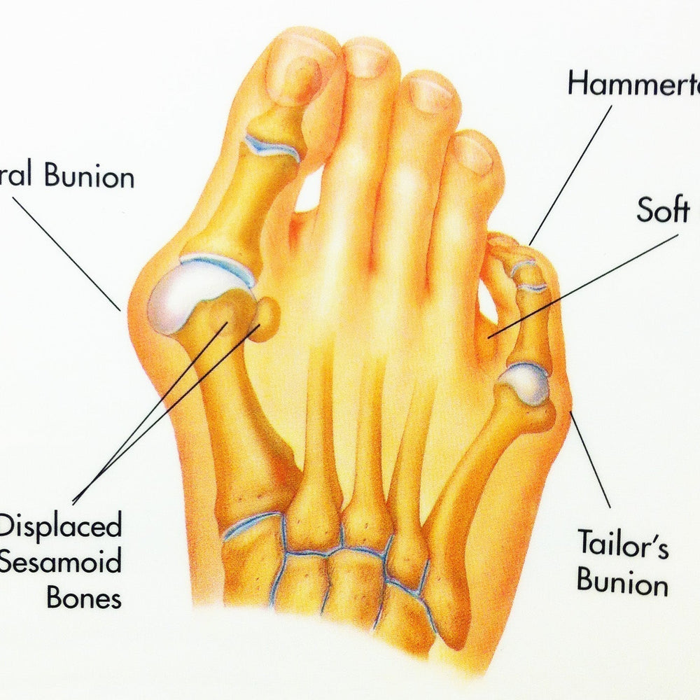 Medical illustration of foot showing structural bunion, hammertoe, tailor’s bunion, soft corn, and displaced sesamoid bones