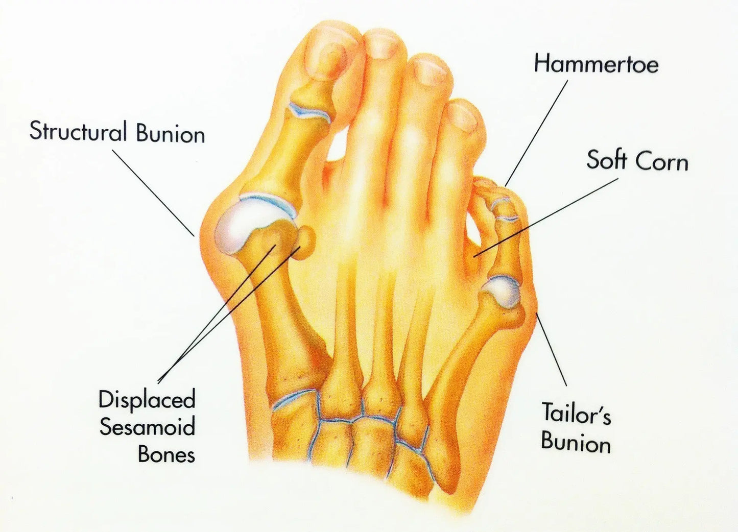 Medical illustration of foot showing structural bunion, hammertoe, tailor’s bunion, soft corn, and displaced sesamoid bones